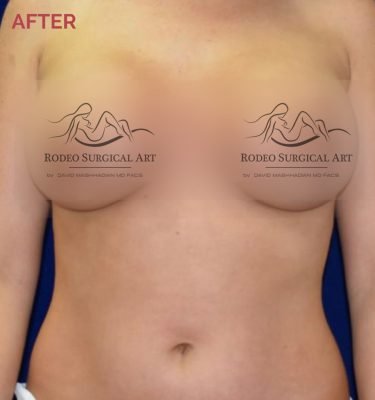Rodeo-GoogleAd-LP-BreastAug-After-with_logo-v2.jpg