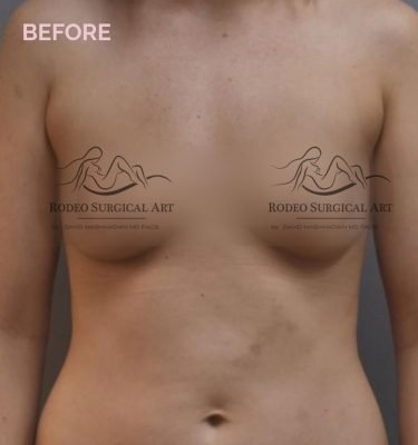 Rodeo-GoogleAd-LP-BreastAug-Before-with_logo-v2.jpg